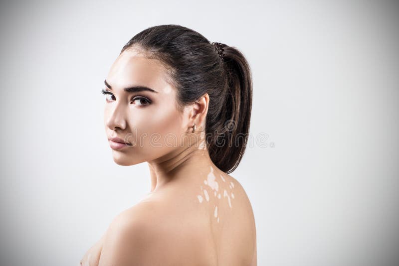 Portret van mooie vrouw met vitiligo royalty-vrije stock foto Portret van mooie vrouw met vitiligo royalty-vrije stock foto