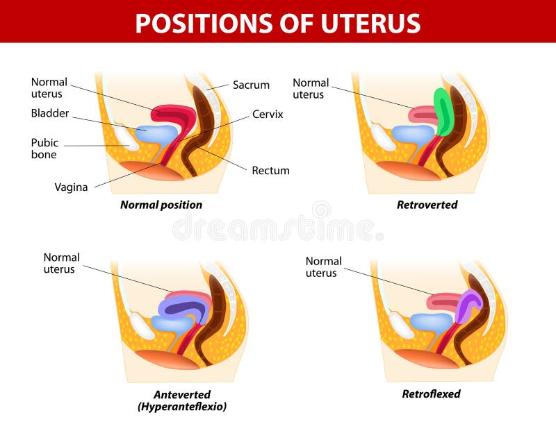 Diagram for variants of uterine position. Normal uterus rests on the superior surface of the empty bladder. Normal Uterus Positions: Anteflexed and Anteverted. Abnormal Uterus Positions: Retroflexed and Retroverted. Diagram for variants of uterine position. Normal uterus rests on the superior surface of the empty bladder. Normal Uterus Positions: Anteflexed and Anteverted. Abnormal Uterus Positions: Retroflexed and Retroverted