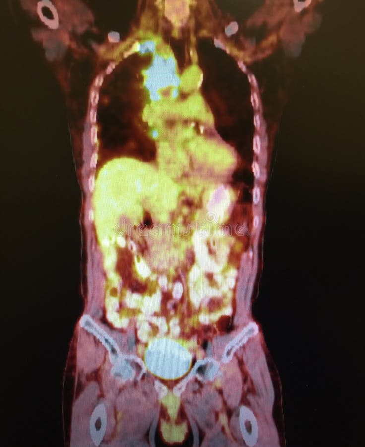 Pet/ct diagnostic on the first place for doctor , which has patient with pathology of mediastinum and penetration to lung , it will allow surgeon to make right decision during operation on. Pet/ct diagnostic on the first place for doctor , which has patient with pathology of mediastinum and penetration to lung , it will allow surgeon to make right decision during operation on.