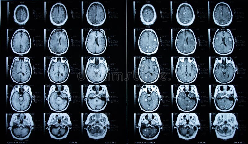 Pre/cérebro MRI contraste do borne