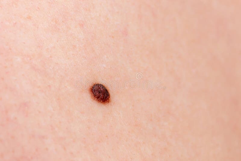 Precancerous Mole Birthmark Is Potentially Cancerous Melanoma Stock