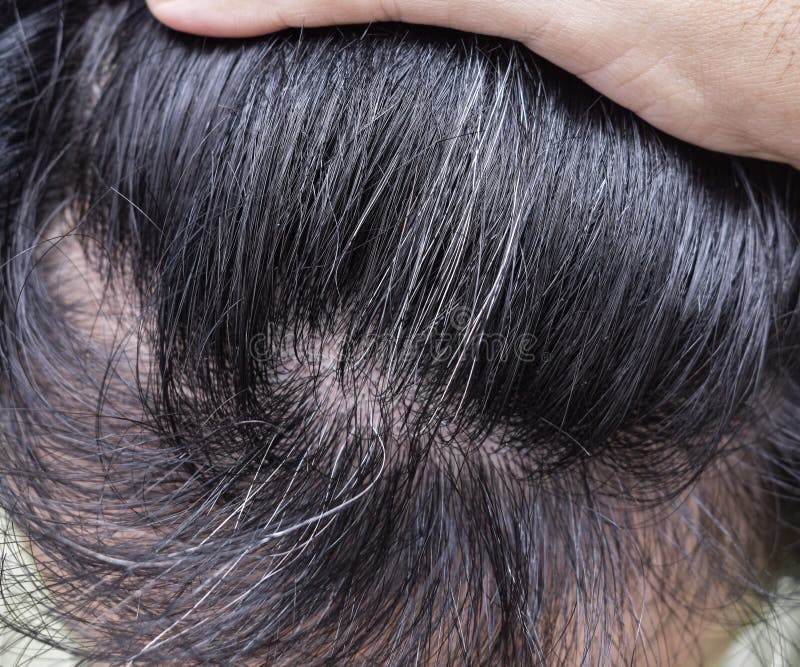 Gray Hair Premature Stock Photos - Free & Royalty-Free Stock Photos from Dreamstime Gray Hair Premature Stock Photos - Free & Royalty-Free Stock Photos from Dreamstime