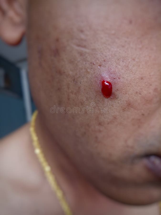 Press the Acne on the Face until Bleeding. Stock Image Image of asian