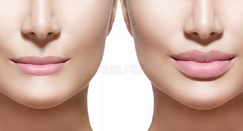 Prima e dopo le iniezioni del riempitore del labbro