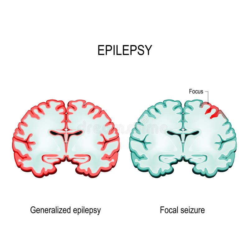 Primary generalized epilepsy and focal seizures