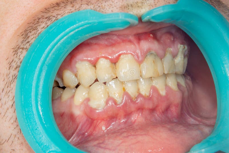 Primer humano de los dientes con la placa dental y la inflamación del gingi imágenes de archivo libres de regalías Primer humano de los dientes con la placa dental y la inflamación del gingi imágenes de archivo libres de regalías