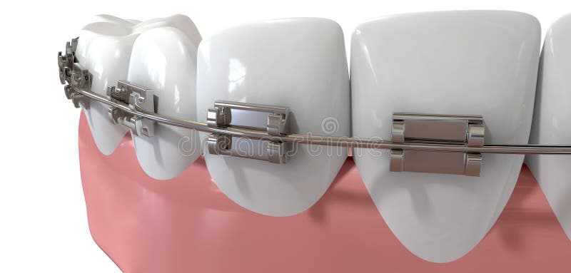 Primo piano estremo dei denti umani con i ganci del metallo