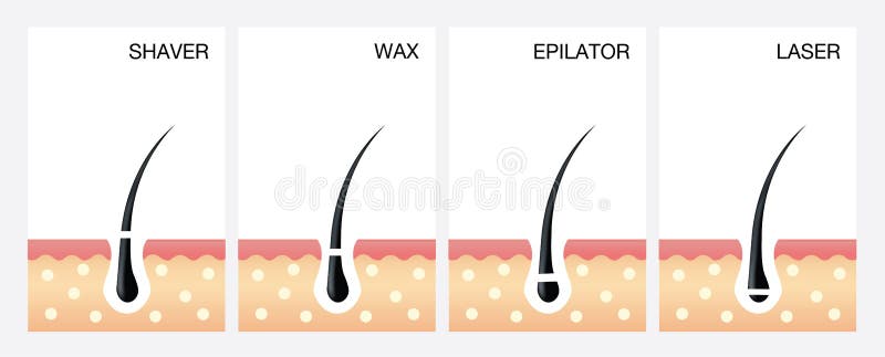 Laser Hair Removal Vector Diagram Stock Illustrations – 195 Laser Hair Removal Vector Diagram Stock Illustrations, Vectors & Clipart - Dreamstime Laser Hair Removal Vector Diagram Stock Illustrations – 195 Laser Hair Removal Vector Diagram Stock Illustrations, Vectors & Clipart - Dreamstime