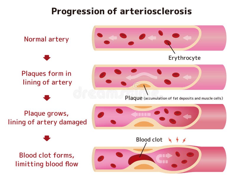 Progression of Arteriosclerosis Illustration Stock Vector