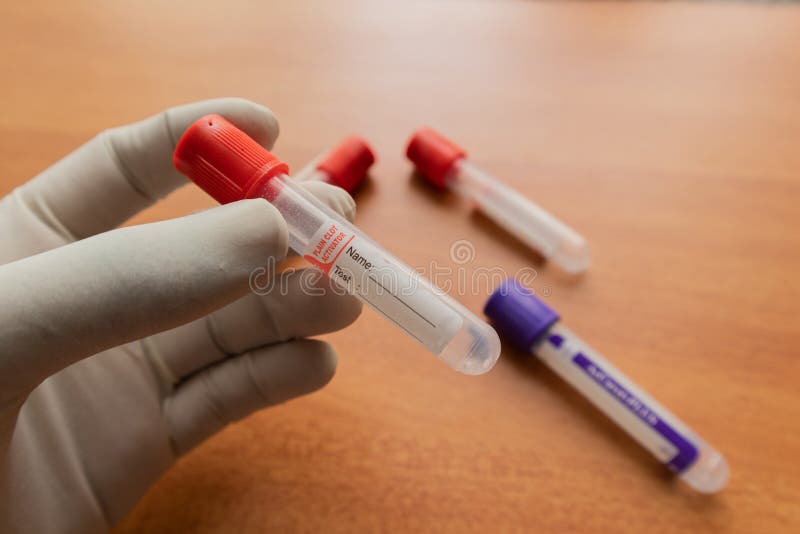 Pro-coagulation Plain Clot Activator blood collection tube,with red plastic stopper held by hand In Laboratory. royalty free stock images Pro-coagulation Plain Clot Activator blood collection tube,with red plastic stopper held by hand In Laboratory. royalty free stock images
