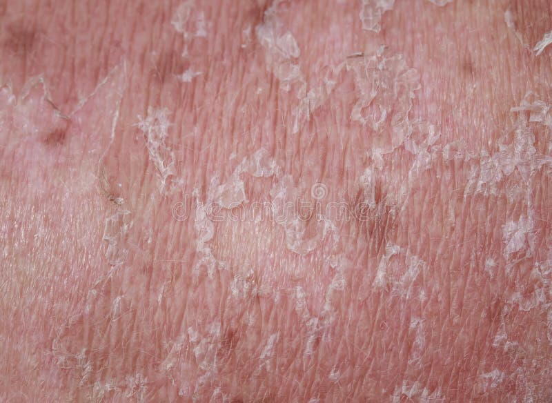 Problem Human Skin Closeup with Burn and Peeling after Sunburn Stock Photo Image of health