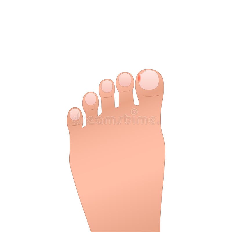 Ingrown Toenail Stock Illustrations – 191 Ingrown Toenail Stock ...