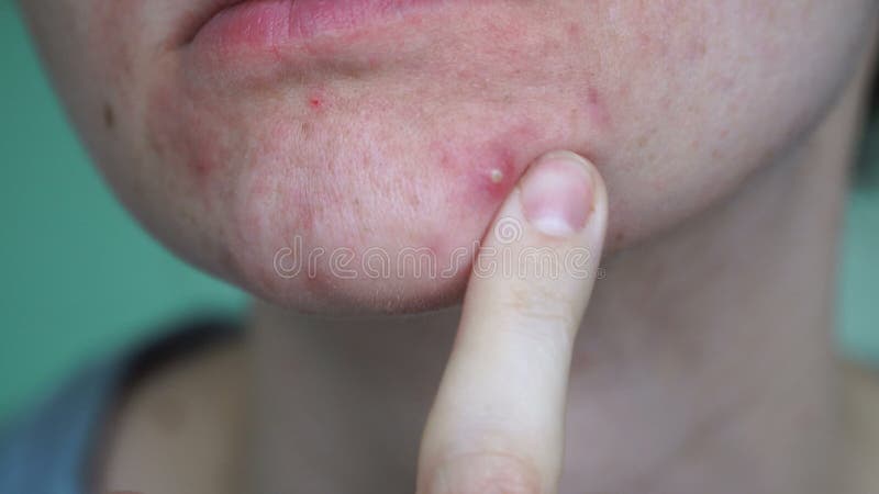 Menina De Scowling Que Aponta Para Sua Acne Com Uma Toalha Em Sua Cabeça.  Conceito Do Cuidado Da Pele Da Mulher, Fotos Da Menina Feia Da Pele Do  Problema No Fundo Branco