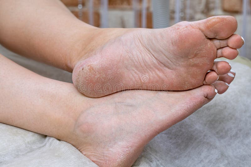 How May A Podiatrist Treat Cracked Heels | Midland Podiatry