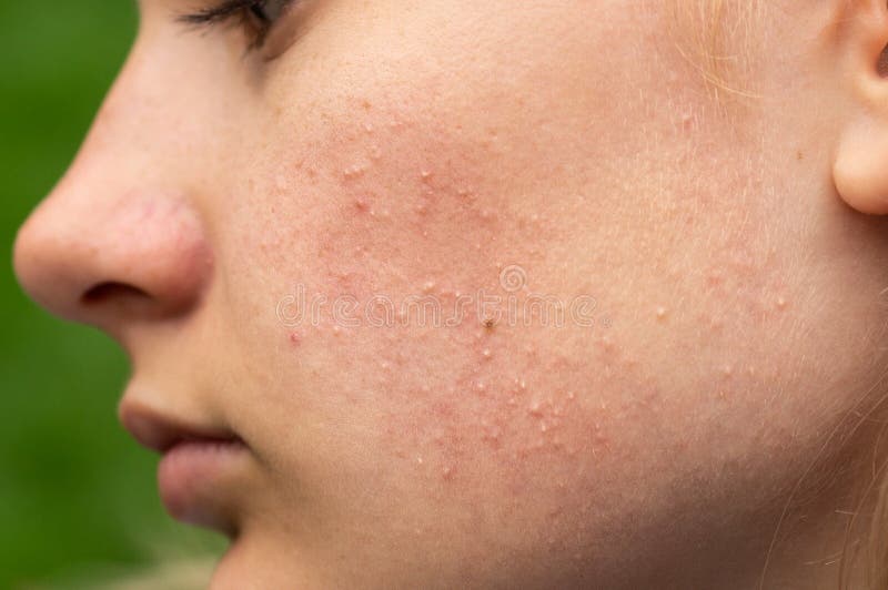 435 Acne Cheek Red Photos - Free & Royalty-Free Stock Photos from Dreamstime