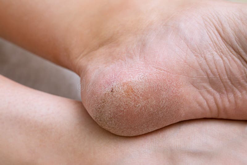 Problematyczna stopa cukrzycowa u kobiety. suche stopy i pęknięte obcasy chorych
