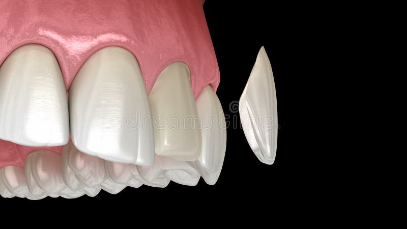 Procedimento de instalação do folheto sobre o incisivo central. ilustração 3d dos dentes com precisão médica