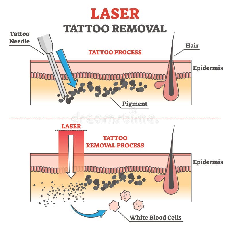 Laser tattoo removal process labeled educational explanation outline concept. Anatomical epidermis side view with pigment under skin vector illustration. Professional cosmetic procedure to erase ink. Laser tattoo removal process labeled educational explanation outline concept. Anatomical epidermis side view with pigment under skin vector illustration. Professional cosmetic procedure to erase ink.