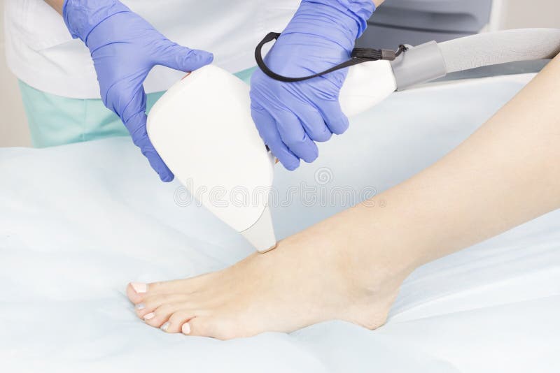 The Process of Laser Depilation of Female Limbs Stock Image Image of