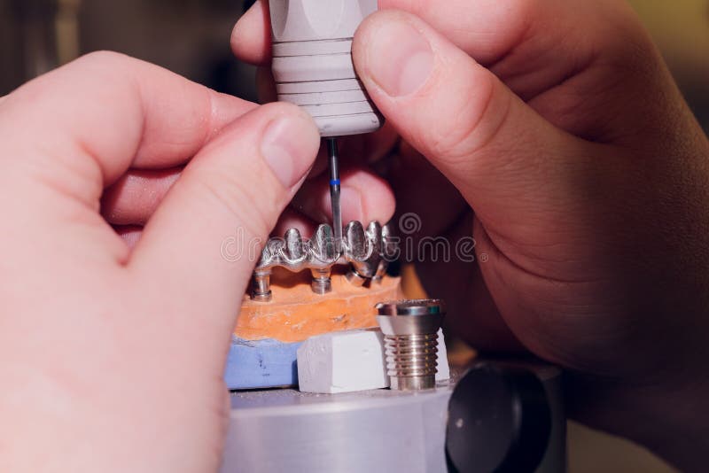 The Process of Making a Dental Prosthesis in a Dental Laboratory. Stock