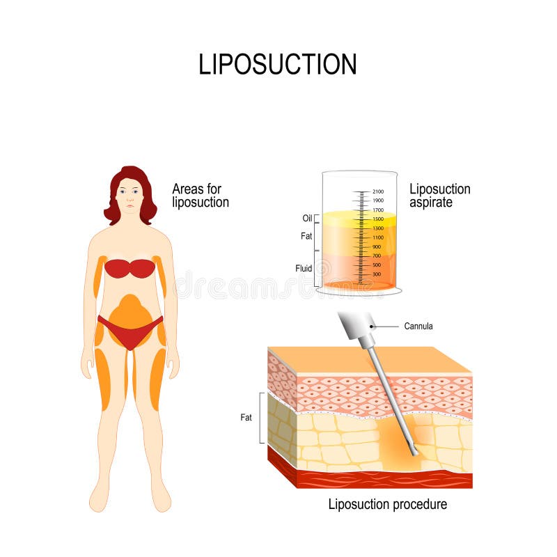 Processo e aree della liposuzione per il lipo illustrazione vettoriale Processo e aree della liposuzione per il lipo illustrazione vettoriale