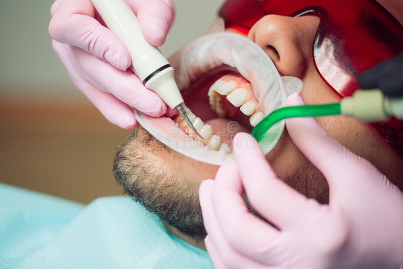 Professional Teeth Cleaning. Dentist Cleans the Teeth of a Male Patient