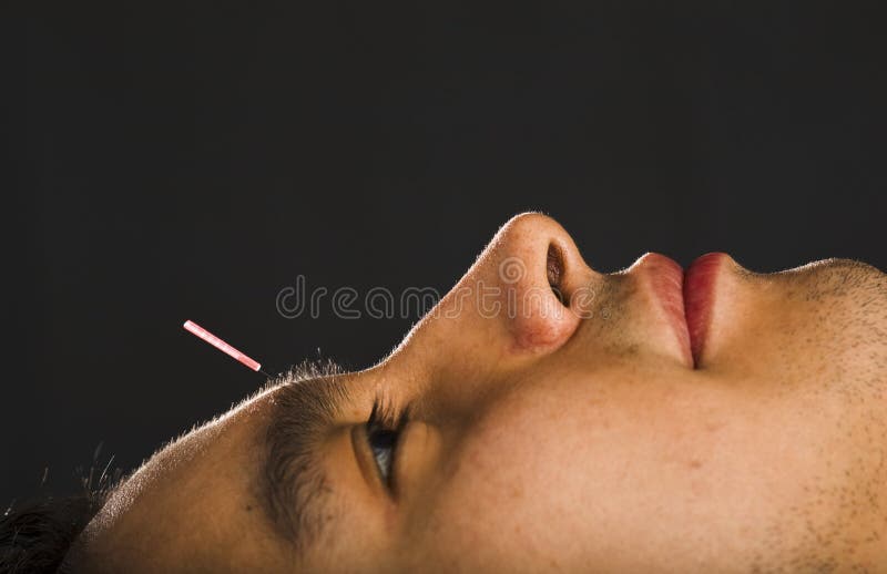 Profil d'acuponcture photo libre de droits Profil d'acuponcture photo libre de droits