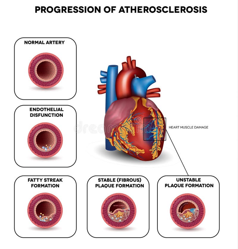 Progression of Atherosclerosis