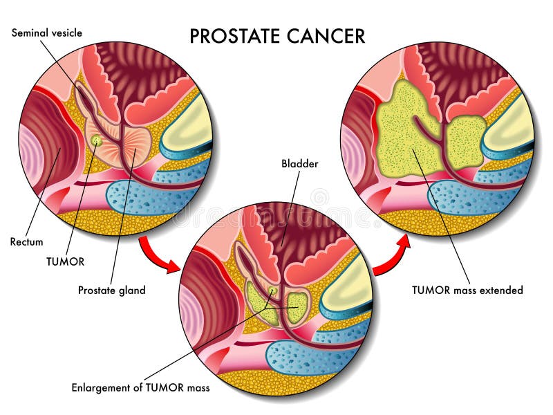 Lekárske ilustrácia účinky rakoviny prostaty.