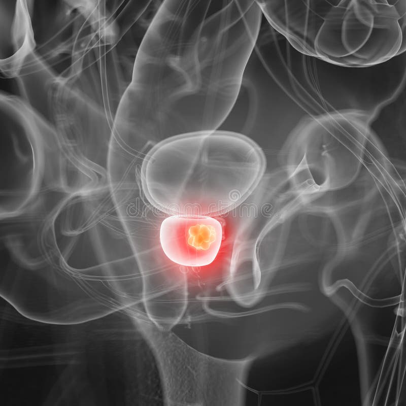 Prostate cancer royalty free illustration