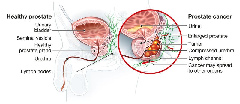 Can prostate cancer spread to brain