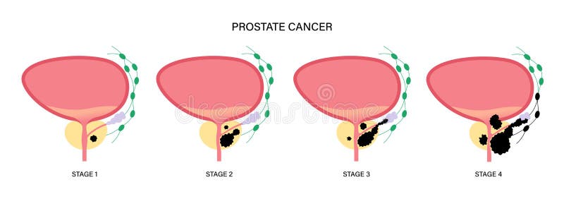 Experiencia de operados de cáncer de vejiga