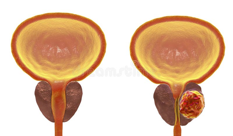 Prostate kanker, illustratie vector illustratie Prostate kanker, illustratie vector illustratie