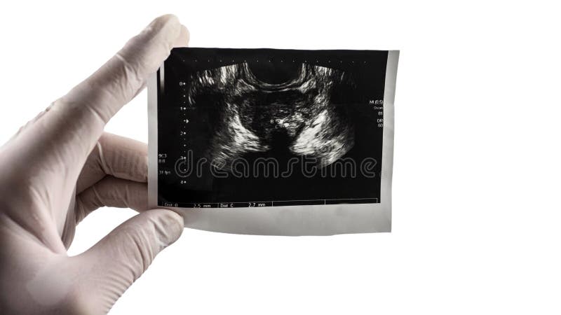 Prostate ultrasound scan on isolated white background, picture of the prostate at the doctor`s hand. Prostata place for text