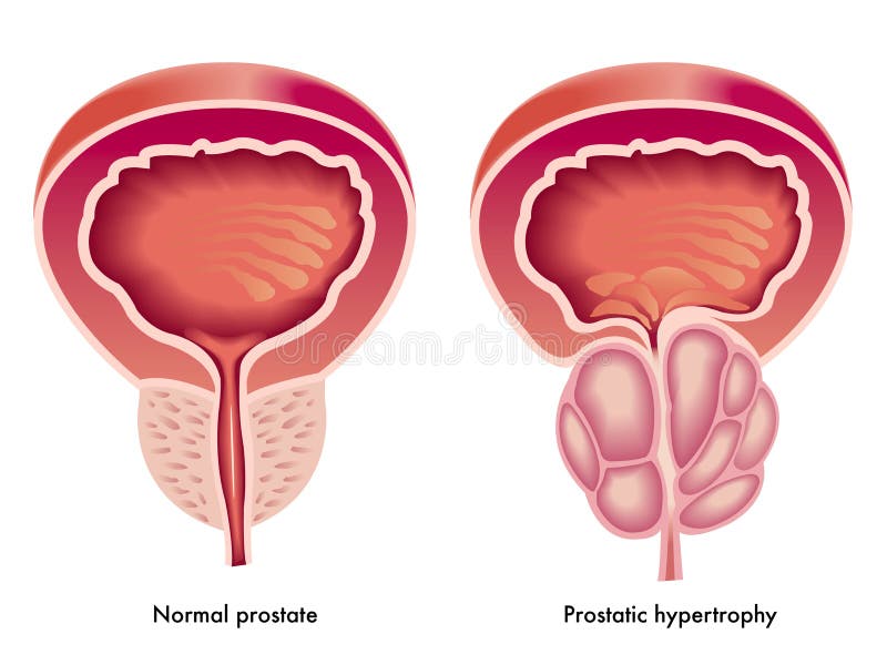 Ilustraciones de efectos de próstata hipertrofia.