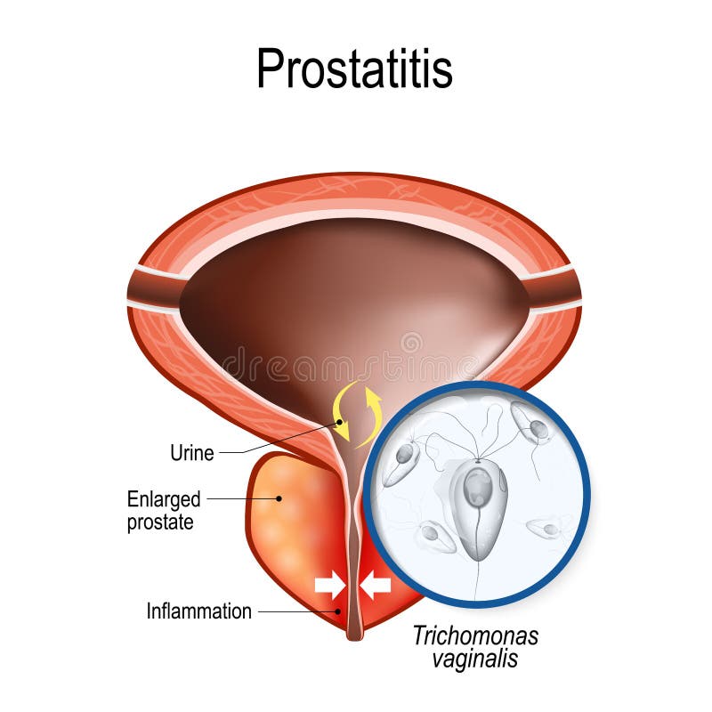 prostatitis urethritisvel