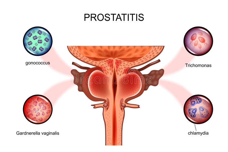 Prostatitis Infecciones sexuales