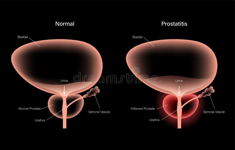 prostatitis és egyenes belek)