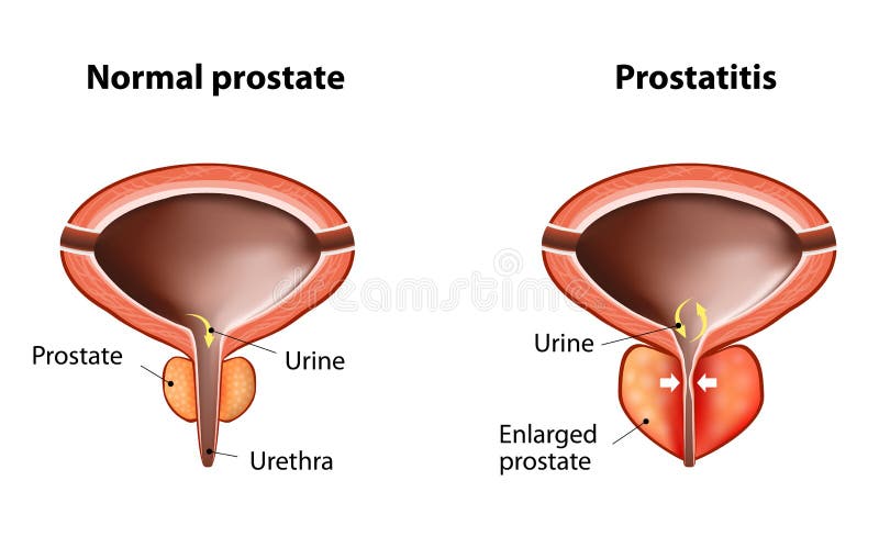 prostatitis prosztatin injekciós prosztatitis