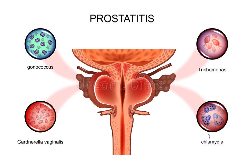 Prostatitis a férfiak kezelési gyakorlatokban stagnáló prostatitis mert mi