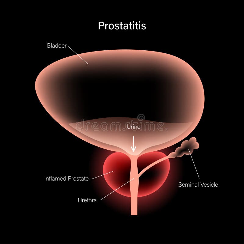 Prostatitis Harbingers Az izmok a prosztatitisekkel fájnak