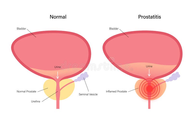prostatitis infertility)