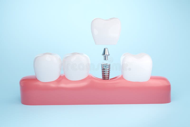 Dental implant with healthy tooth and gums, Dental crown and bridge treatment concept. Dental implant with healthy tooth and gums, Dental crown and bridge treatment concept.