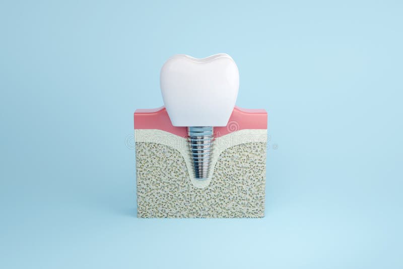 Teeth dental implant with gums on blue background. 3D rendering. Teeth dental implant with gums on blue background. 3D rendering