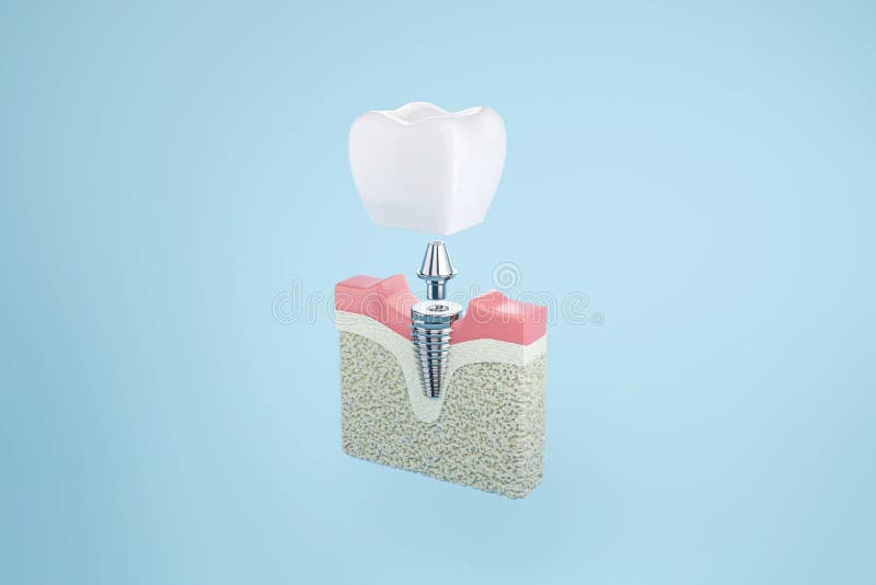 Tooth dental implant with layer of gums on blue background. 3D rendering. Tooth dental implant with layer of gums on blue background. 3D rendering