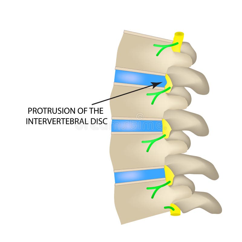 Protrusion of the Intervertebral Disc. Vector Illustration on Isolated