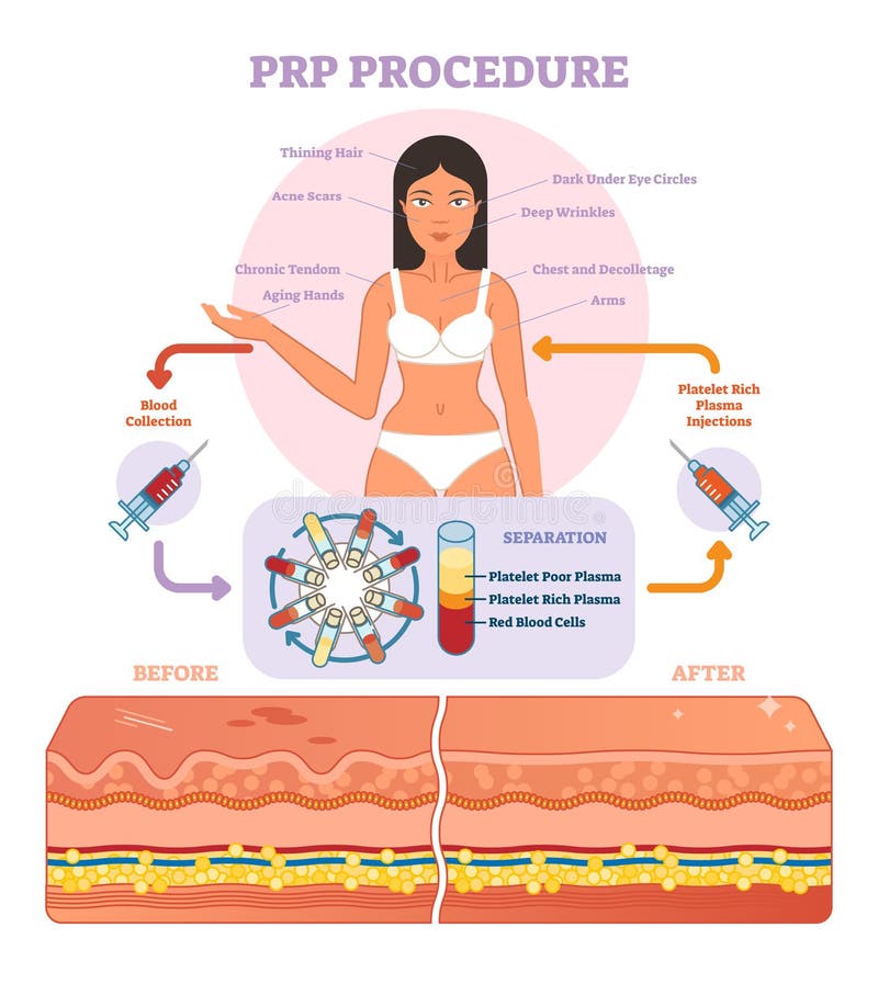 PRP Procedure vector illustration graphic diagram, cosmetology procedure scheme. Women beauty and skincare. PRP Procedure vector illustration graphic diagram, cosmetology procedure scheme. Women beauty and skincare.