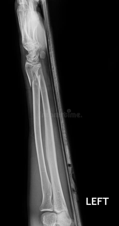 Przełamu dyszel promieniomierz & ulnar kość zdjęcie stock Przełamu dyszel promieniomierz & ulnar kość zdjęcie stock