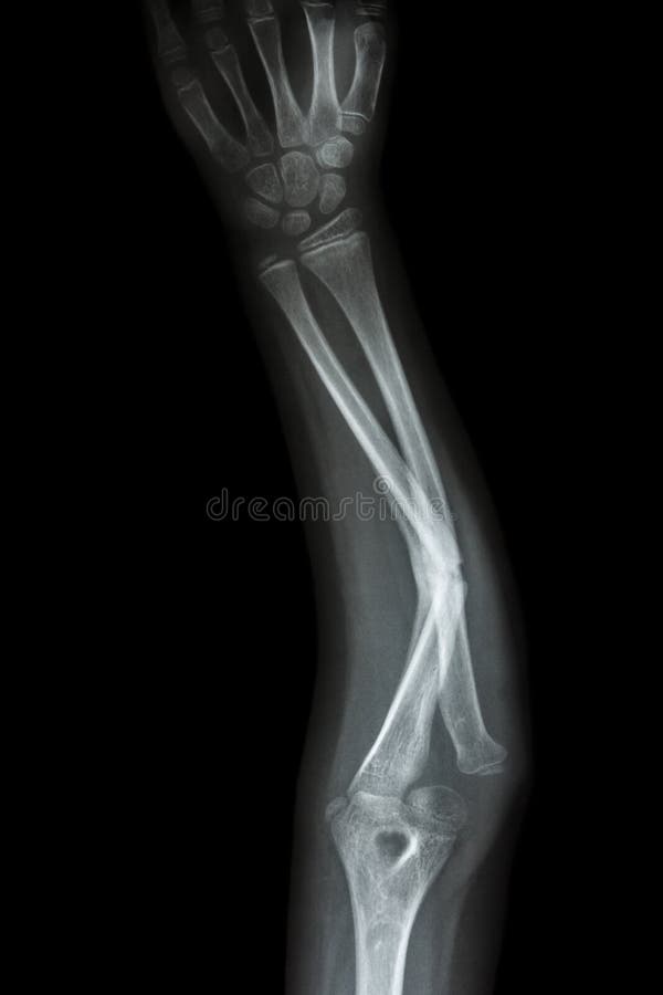 Przełamu dyszel ulnar (przedramię kość) zdjęcia royalty free
