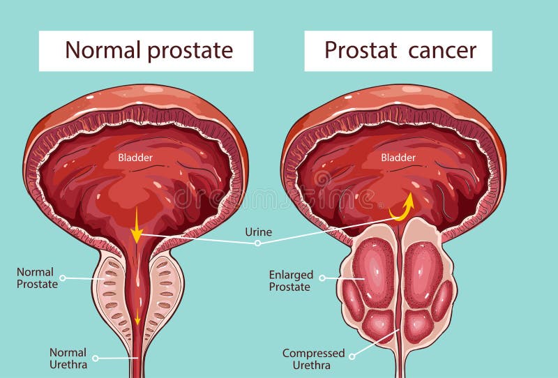  Próstata normal e prostatite aguda Ilustração médica ilustração do vetor